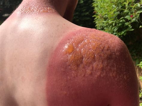 Sweat blisters caused by sunburn. Man warns of dangers of sun exposure after getting 2nd ...