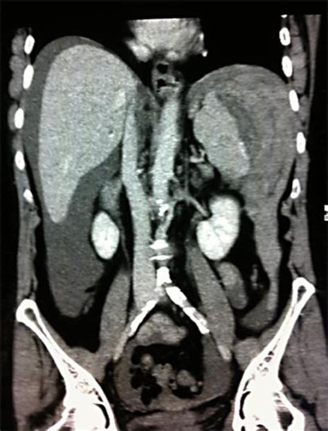 Coronal Section Ct Scan Of The Abdomen Revealing Hemoperitoneum And A