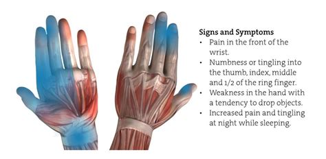 Carpal Tunnel Syndrome Physio Pooja