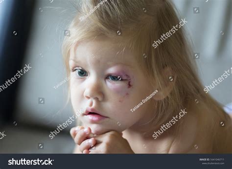 5985 Bruises Child Images Stock Photos And Vectors Shutterstock