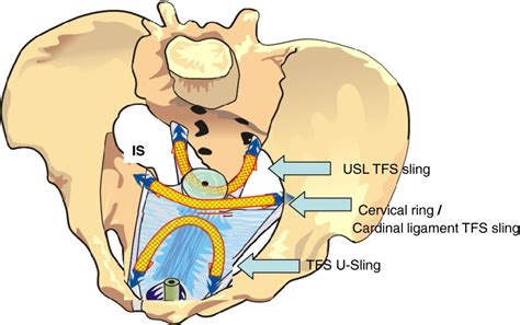 Tfs For Pelvic Organ Prolapse Pop Cervical Ring Cardinal Ligament