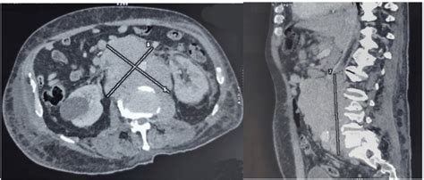 Voluminous Retroperitoneal Lymph Nodes In Transversal And Sagittal