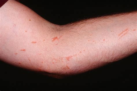 What Does Poison Ivy Rash Look Like
