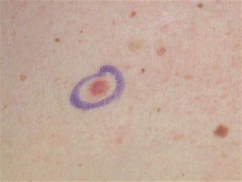 Early Stage Skin Cancer Moles On Back Steve