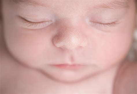ᐅ Milia bei Neugeborenen und Babys Arten Ursachen und Behandlung
