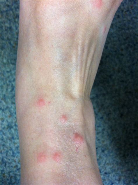 Chigger Bites On Ankles And Feet Summers Acres