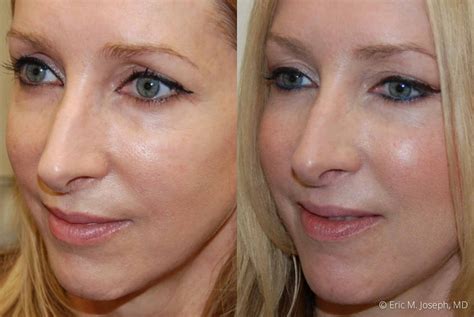Eric M Joseph Md Silikon Before After Lip Smoothing And