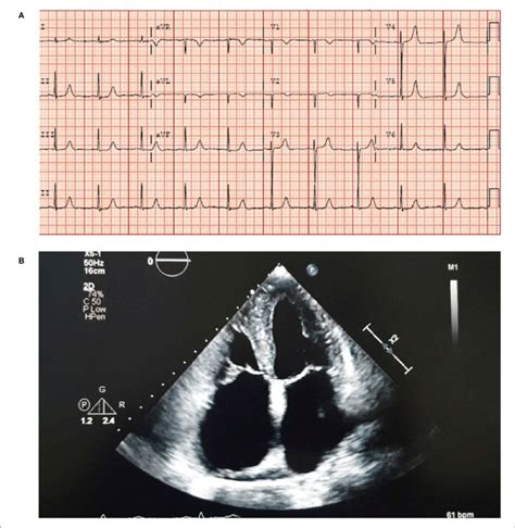 Ecg A Showing Sinus Rhythm With Lvh And A Borderline Prolonged Qt