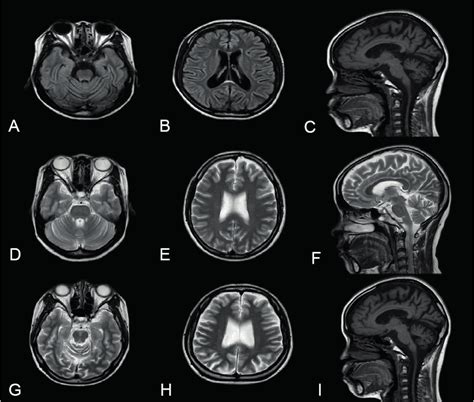Brain Mri And Brain Ct In Patients With Drpla Each Image Shows Diffuse