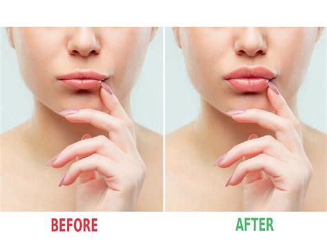 With hyaluron pen, you can expect effective results the hyaluron pen is an innovation that deposits hyaluronic acid filler into the skin's epidermal and upper dermal layers without traditional needles. Fort Myers Hyaluron Pen Needle Free Injections | Naples, FL