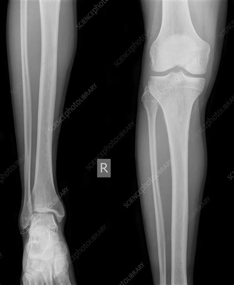 Right Knee X Ray Stock Image C0564198 Science Photo Library