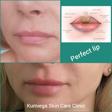 Lip Augmentation And Modelling Kumiega