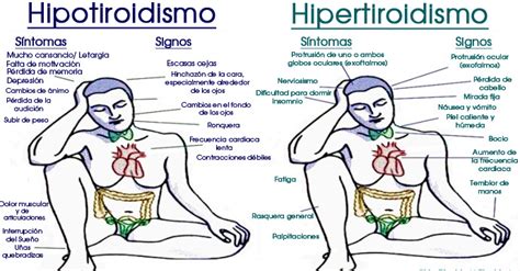 Signos Y S Ntomas Del Hipotiroidismo E Hipertiroidismo