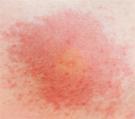 Pictures Of Skin Rashes Lovetoknow