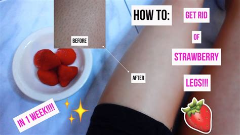 How To Get Rid Of Strawberry Legs In 1 Week Youtube