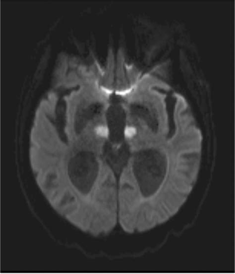 Example Of Bilateral Paramedian Ischemic Lesion In The Thalamus Dwi