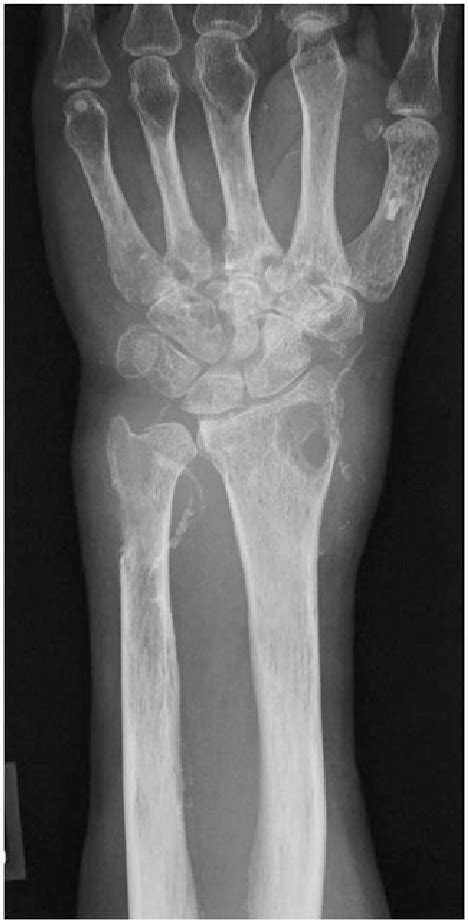 Preoperative Radiograph Showing An Osteopenia With Marginal Erosions