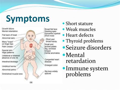 Ppt Down Syndrome Powerpoint Presentation Free Download Id5944198
