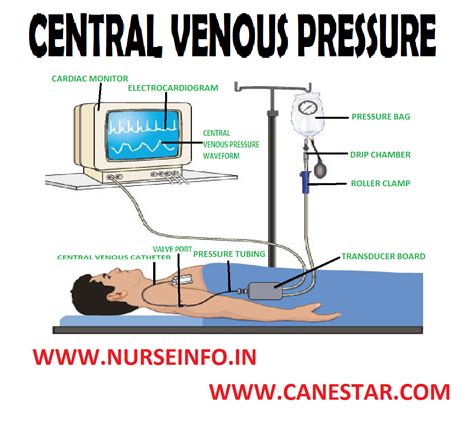 Central Venous Pressure Nurse Info