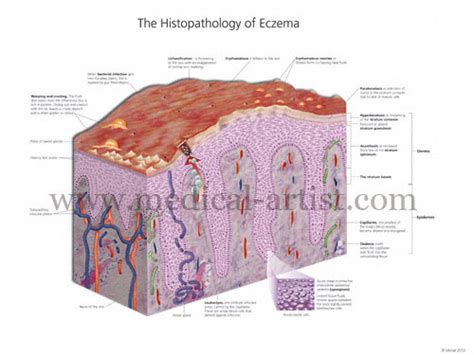 Medical Illustrations Of Stages Of Eczema And Histopathology Of Eczema