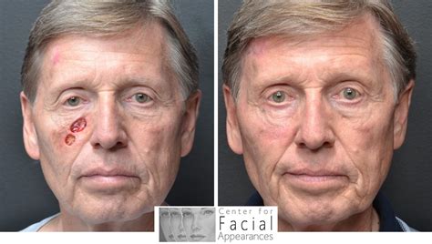 Skin Cancer Face Before After Center For Facial Appearances
