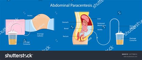 Ascites Paracentesis Medical Procedure Diagnostic Abdominal Stock