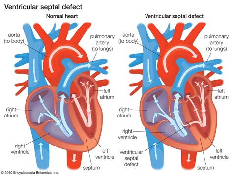 Atrial And Ventricular Septal Defects