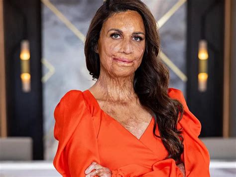 Turia Pitt Before And After Burns What Exactly Happened