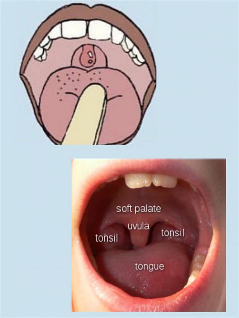 Uvula Cancer