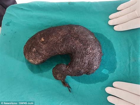 doctors remove melon sized hairball from the stomach of a teenage girl addicted to eating her