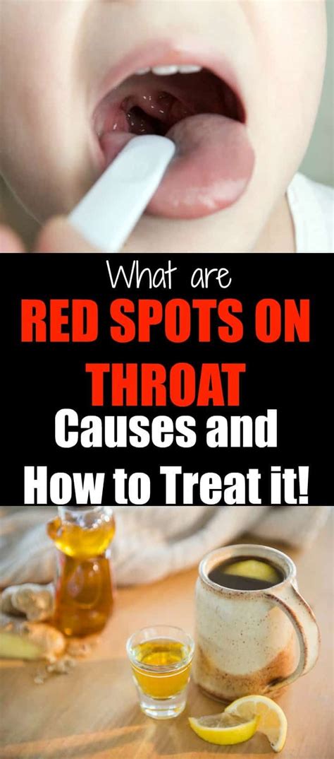 What Are Red Spots On Throat Causes And How To Treat It Treat Sore