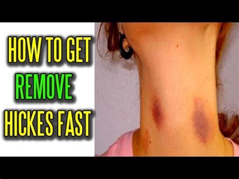 So how do i get rid of a hickey? How To Get Rid Of Hickies Fast | How to Get Rid of Hickeys ...