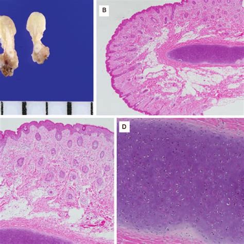 Gross Finding And Histopathologic Findings Of Excised Bilateral