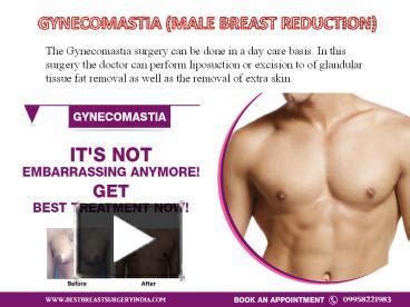 Ppt Male Breast Reduction Gynecomastia Surgery In Delhi India Powerpoint Presentation
