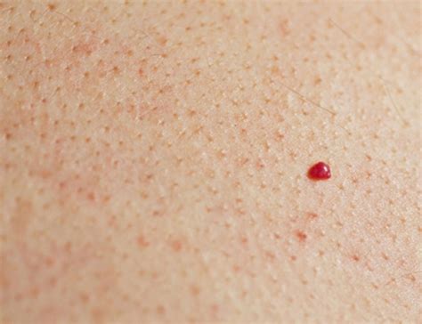 Red Dots On Skin Pictures Causes Treatment And When T Vrogue Co
