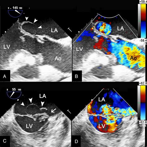 Large Mitral Valve Aneurysm With Infective Endocarditis Bmj Case Reports