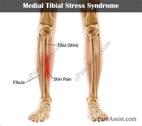Medial Tibial Stress Syndrome Mtss Shin Splints Capital Area Pt