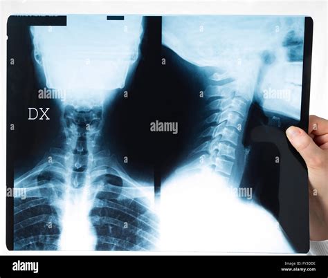 radiografia del collo delle vertebre cervicali immagini e fotografie stock ad alta risoluzione