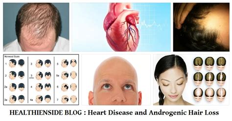 (different diseases associated with specific. Is Heart Disease Associated with Androgenic Hair Loss?