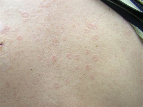 Clinical Challenge Asymptomatic Rash On The Trunk Mpr