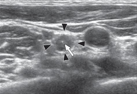 Swollen Lymph Nodes In Neck Ultrasound