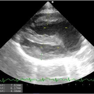 Right Parasternal Long Axis View Of The Heart With Severe Right Atrial