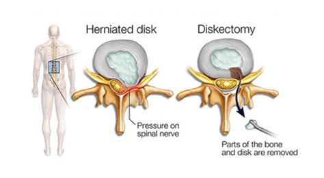 Discectomy Surgery In India Pain Relief Cost Hospital Doctor