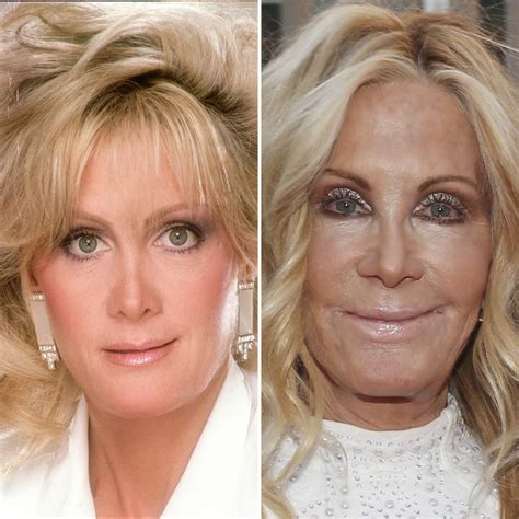 Joan Van Ark Plastic Surgery With Before And After Photos