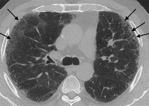 Fibrosing Lung Disease Radiology Key