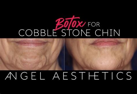 Botox For Cobblestone Chin Aka Orange Angel Aesthetics