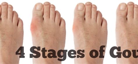 The Four Stages Of Gout Gout Share