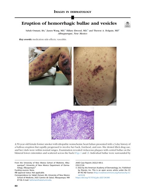 Pdf Eruption Of Hemorrhagic Bullae And Vesicles