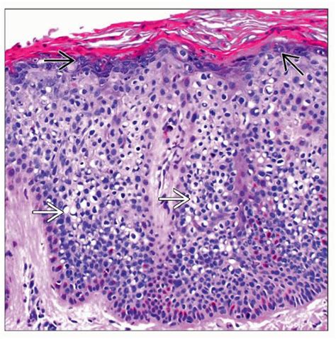 Squamous Cell Carcinoma In Situ Bowen Disease Basicmedical Key