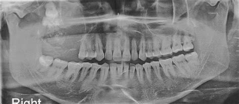 Orthopantomograph Revealing An Impacted Third Molar At The Infraorbital